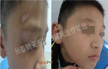 门诊病例：10岁男孩脸部白癜风1年半