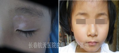 门诊案例：5岁女孩眼部白癜风2个月